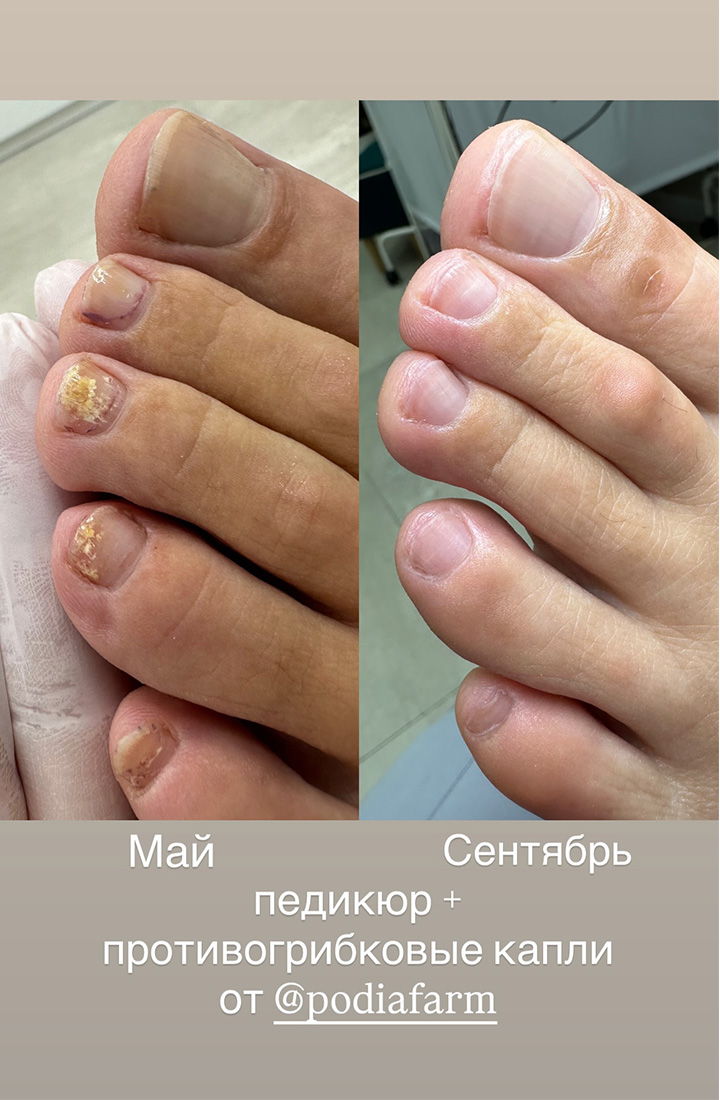 отзыв 15 противогрибковые капли Podiafarm